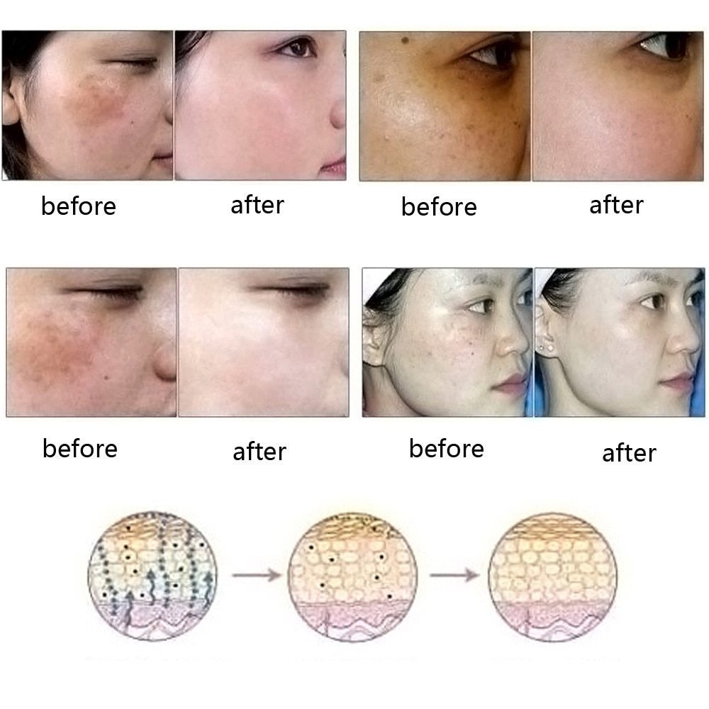 Removal Acne Stretch Marks Scar Removal Essence oil