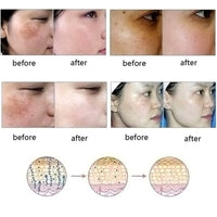 Removal Acne Stretch Marks Scar Removal Essence oil