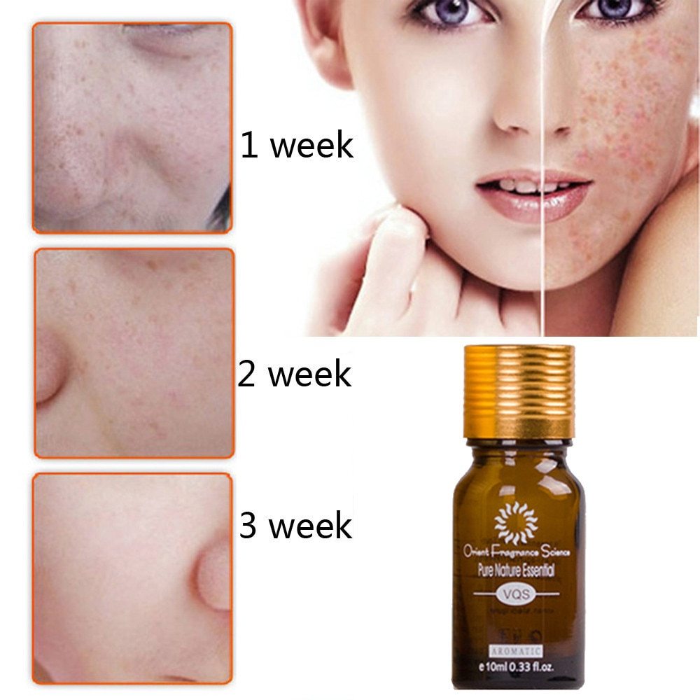 Removal Acne Stretch Marks Scar Removal Essence oil